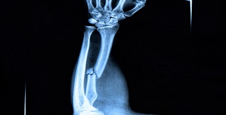 xray of broken arm